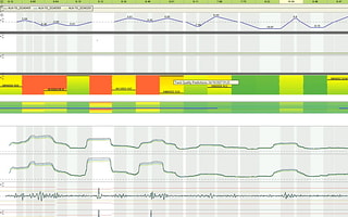A linear analytics dashboard in AssetWise Linear Analytics, displaying synchronized charts of railway track geometry and condition data.